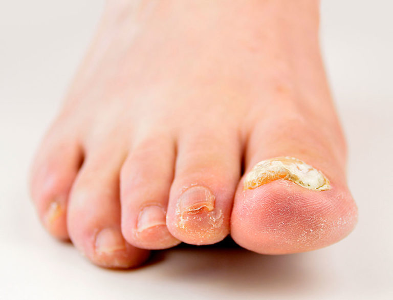 Nagelkrankheiten Fußnägel Krankheiten Erkennen Bilder www.dermazentrumzuerich.ch